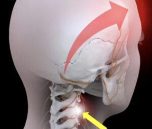 Cervicogenic headache